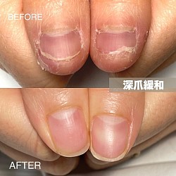 深爪緩和