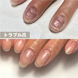 トラブル爪