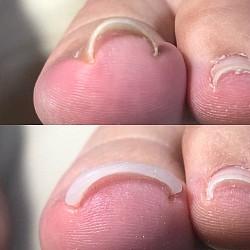 巻き爪ケア